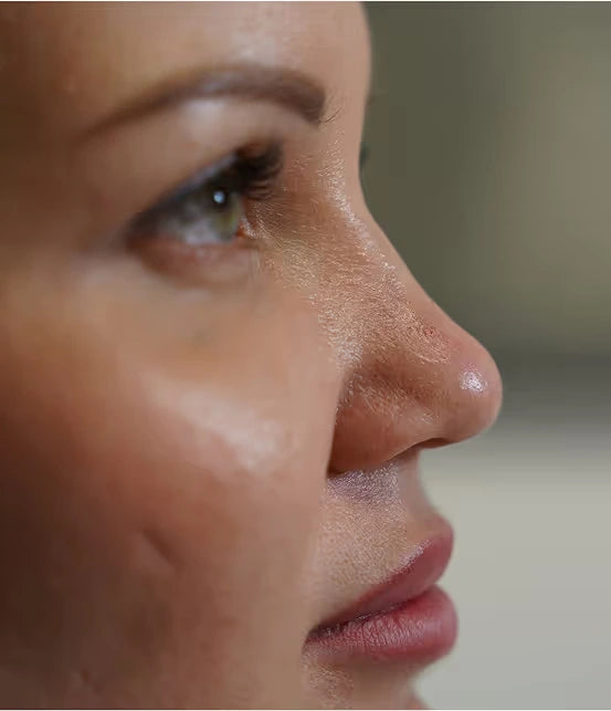 MesoSculpt C71® vor der Behandlung