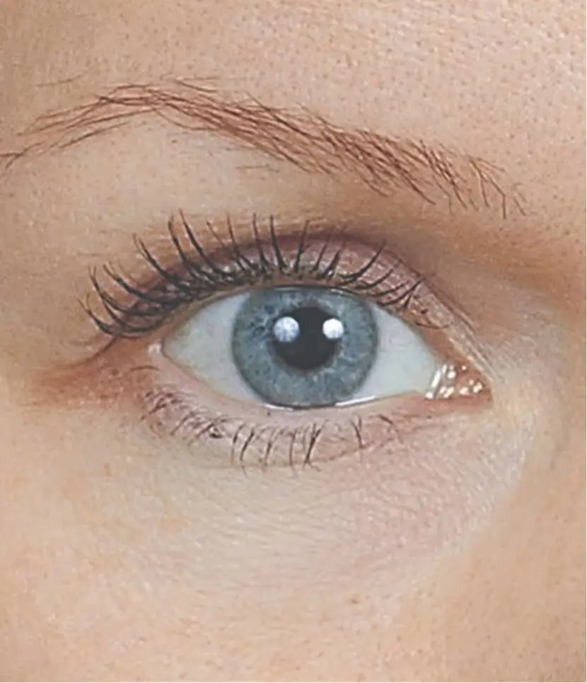 MESOEYE C71 Nachher