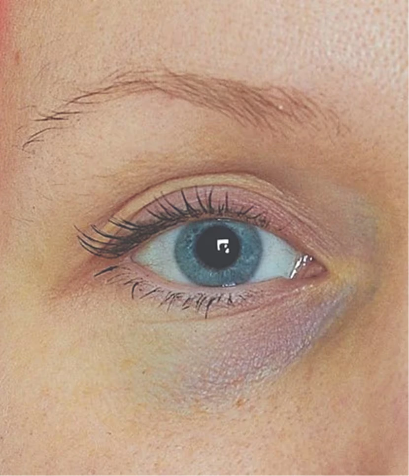 MesoEye C71® vor der Behandlung